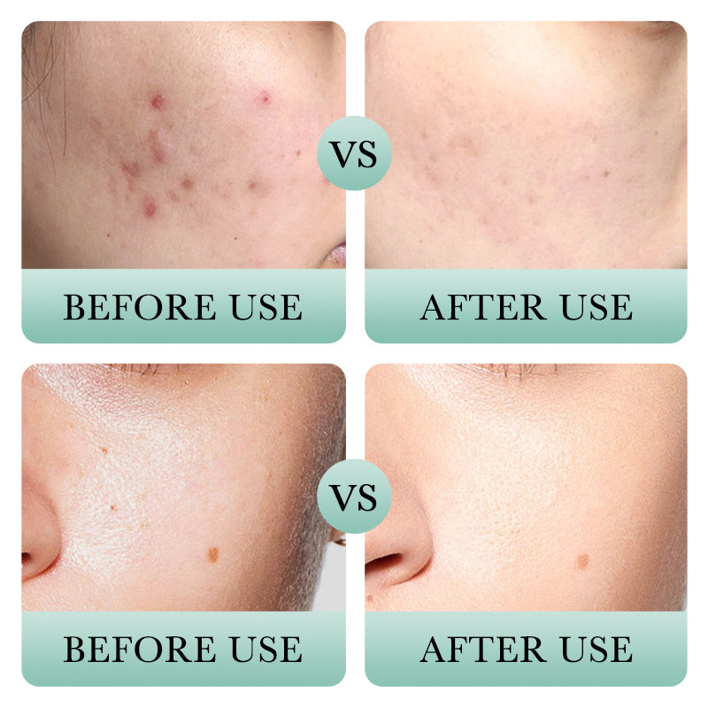 BIOAOUA Salicylic Acid Acne Removal Cleanser 100g