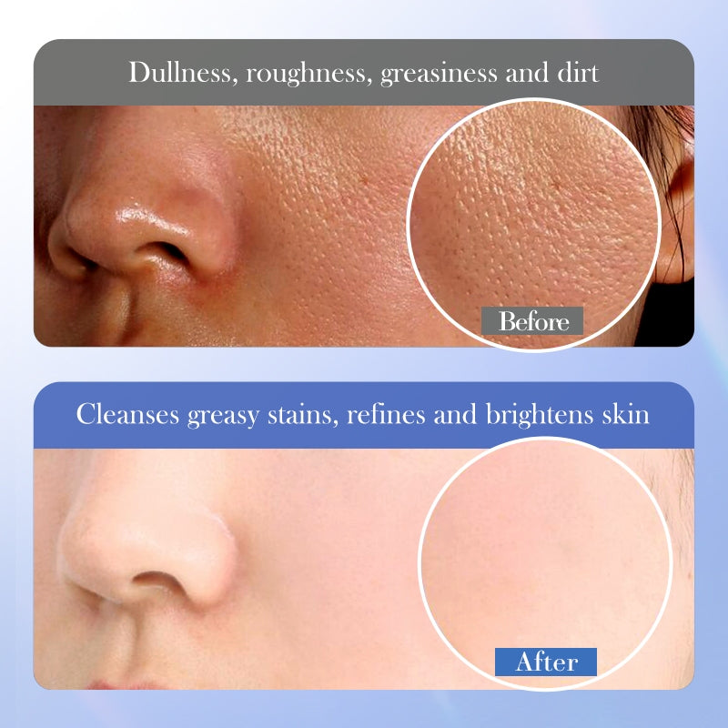 BIOAOUA Salicylic Acid Cleanser Oil Control Acne Treatment Cleanser  Pore Cleansing 100g