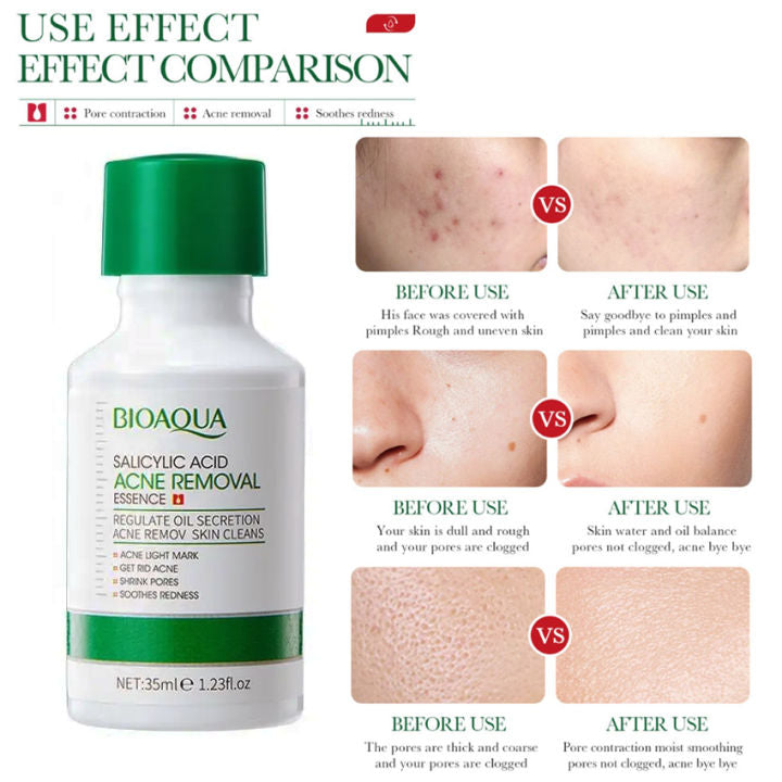 BIOAOUA Salicylic Acid Pore Refining Serum Moisturizing Acne Treatment Serum Skin Care 30ml